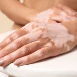Vitiligo
